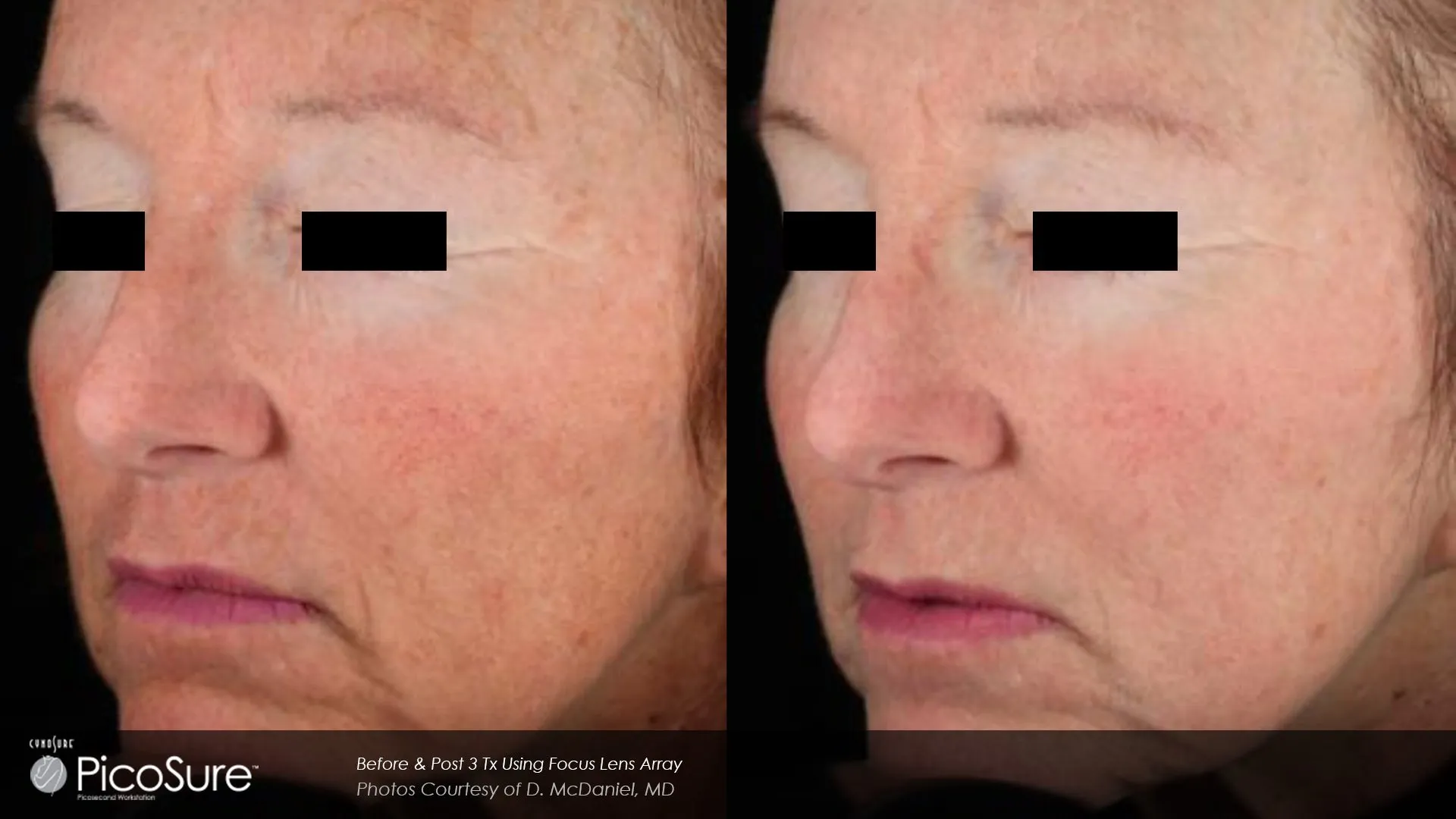 Wrinkle reduction results